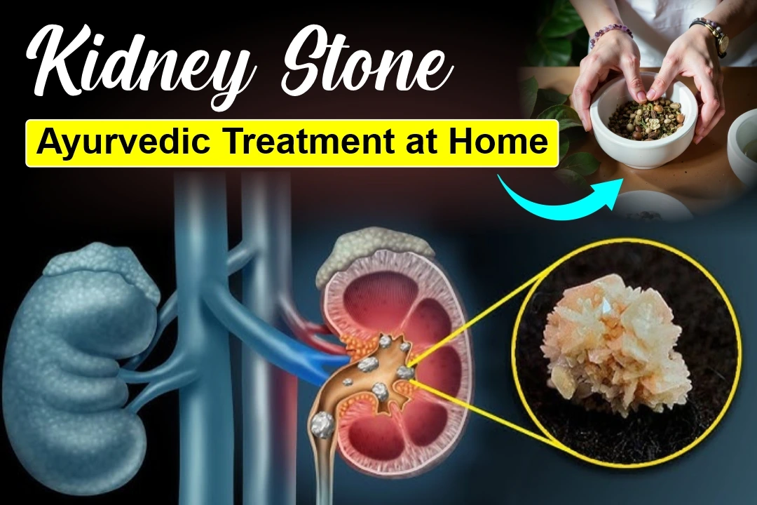 How to Remove Kidney Stones Naturally at Home with Ayurveda?